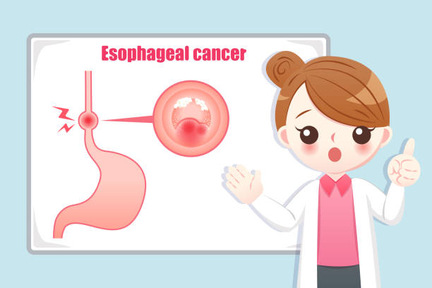 esophageal cancer 