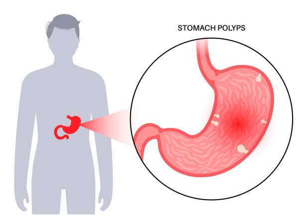 गैस्ट्राइटिस और पेप्टिक अल्सर (Gastritis and peptic ulcers)