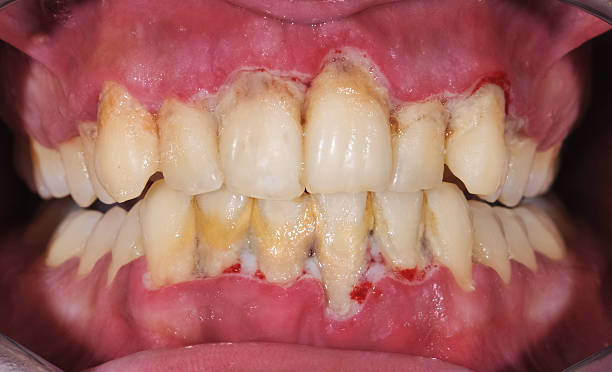 teeth disease 