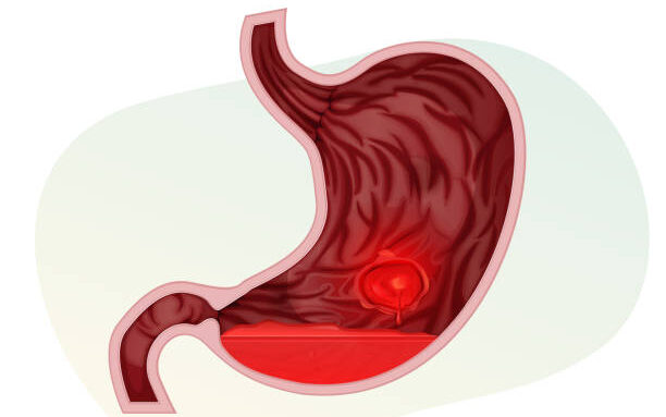 stomach ulcers