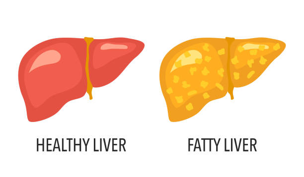 फैटी लिवर (fatty liver) 