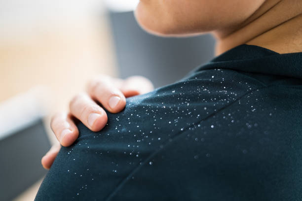 dandruff 
रूसी 