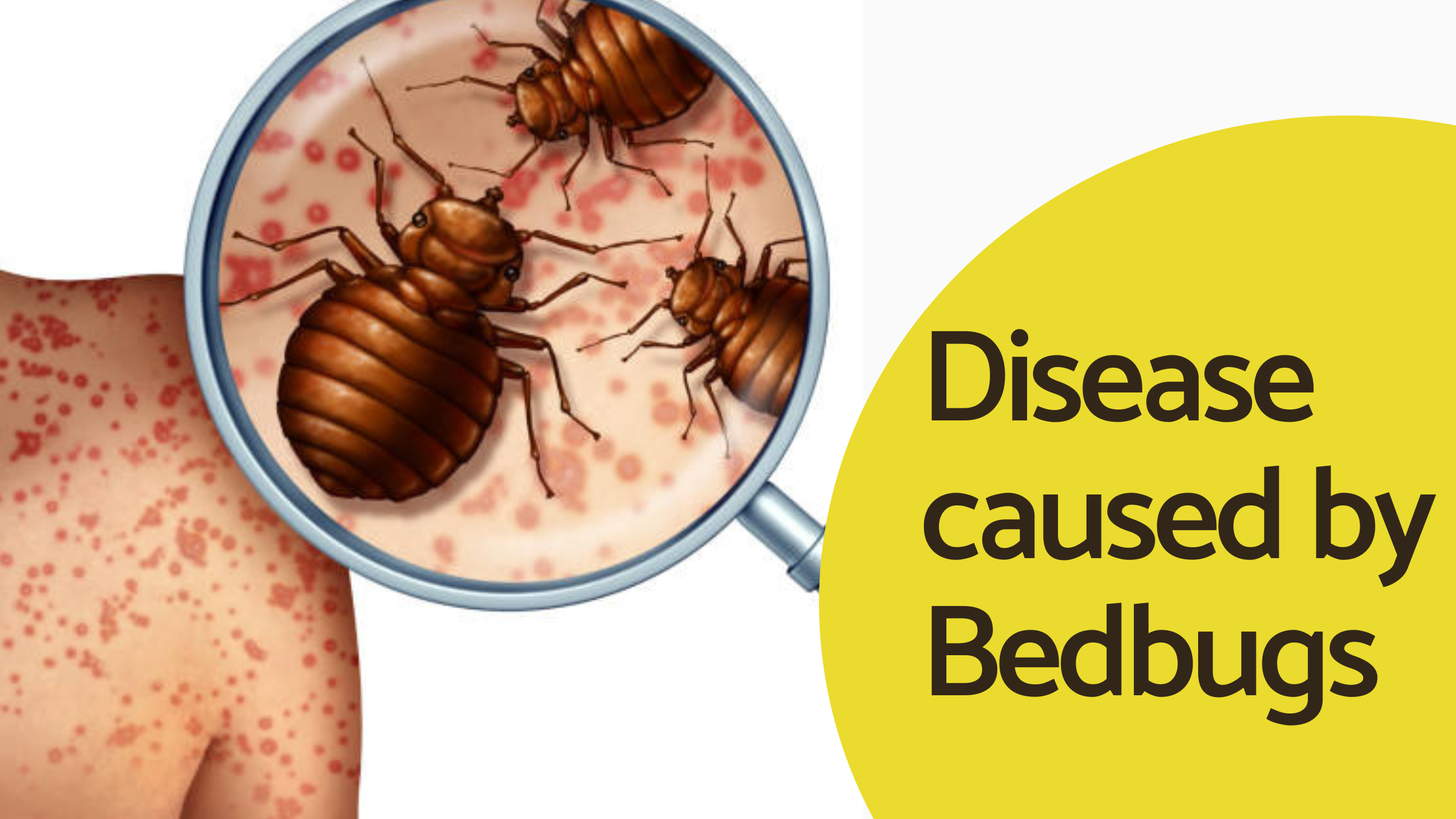 Disease caused by Bedbugs