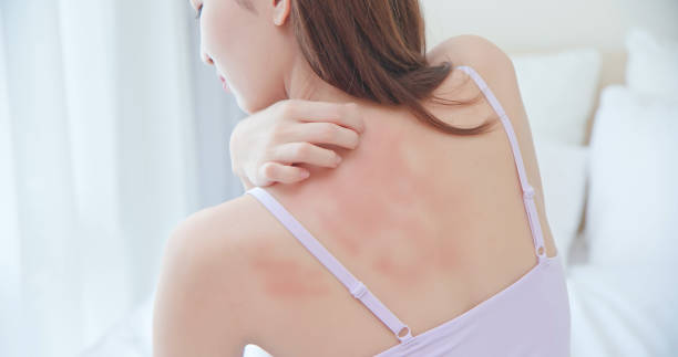 स्किन एलर्जी skin allergy 