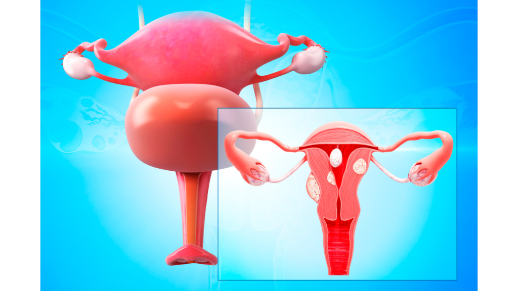 treatments of PCOD (Polycystic Ovary Syndrome)